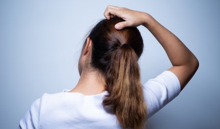 viszkető fejbőr-haj-seborrheás dermatitis
