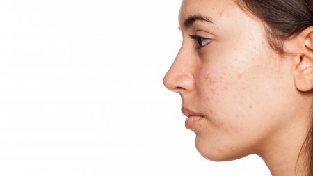 PIH, gyulladás utáni hiperpigmentáció bioderma-your-skin_pigmentbio_c-concentrate_woman_face