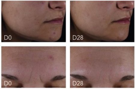 sebium serum before