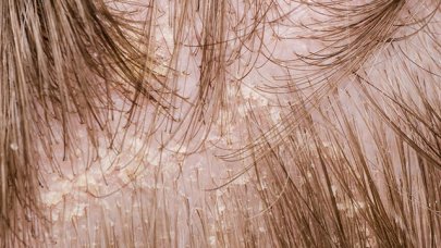 Psoriasis a hajas fejbőrön? Van megoldás! | FranklPharma