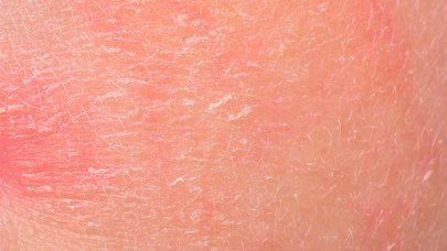 pikkelysömör kezelése dermatitis