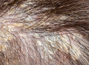 fejbőrön jelentkező seborrheás dermatitis fejbőrön jelentkező seborrheás dermatitis